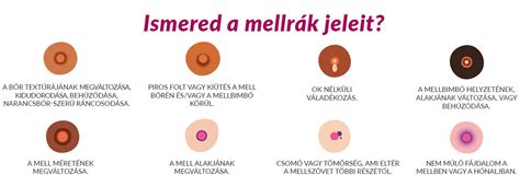 Gangl Edina a mellrák elleni kampány arcaként