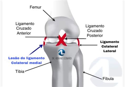 Térdszalagok diagramja, ACL kiemelve