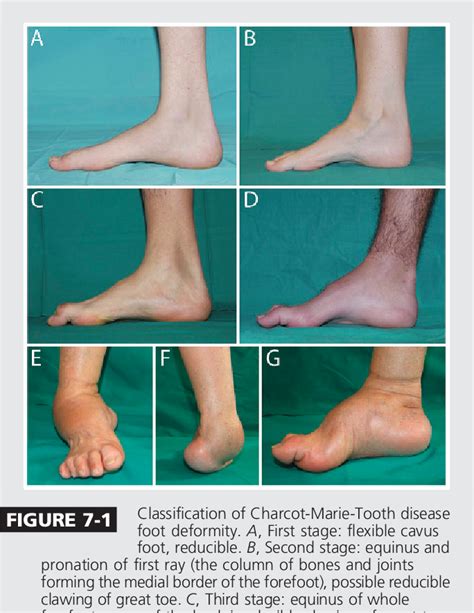 A Charcot-Marie-Tooth szindróma idegkárosodásának sematikus ábrája