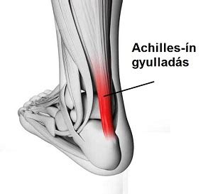 Az Achilles-ín anatómiája és a leggyakoribb sérülései