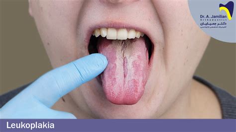 Leukoplakia a szájban