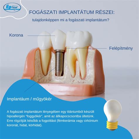 Fogpótlási lehetőségek összehasonlítása: híd és implantátum