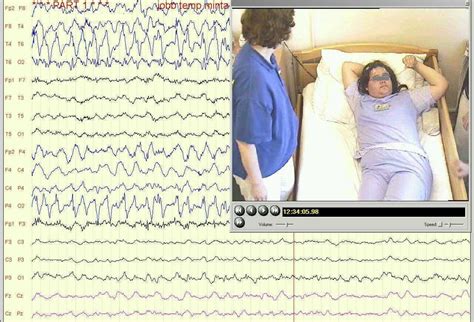 EEG felvétel illusztrációja a rohamok alatt