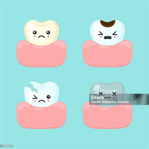 Illusztráció a fogszuvasodás folyamatáról