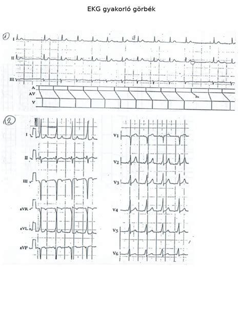 EKG görbék és szívritmuszavarok vizualizációja