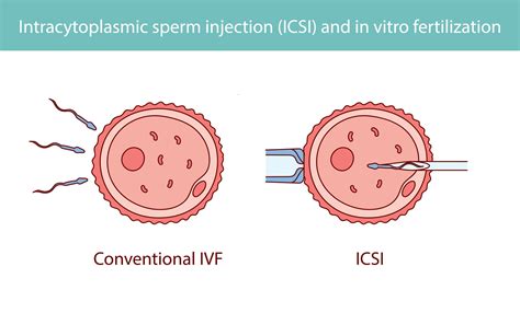 Az IVF eljárás lépései donor petesejttel
