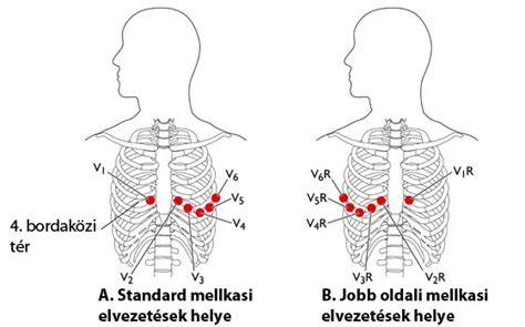 A szív elektromos működése és az EKG elektródák elhelyezése