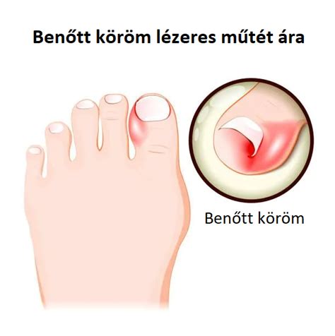 benőtt köröm és körömágygyulladás ábrázolása