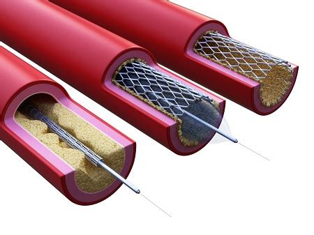 A szívinfarktus mechanizmusa és a sztent beültetés