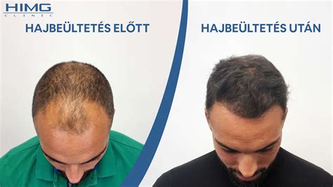 David Silva hajbeültetés előtt és után